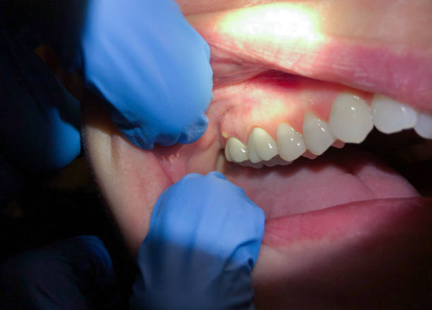 Best Emergency Wisdom Teeth Removal in Allegan, MI