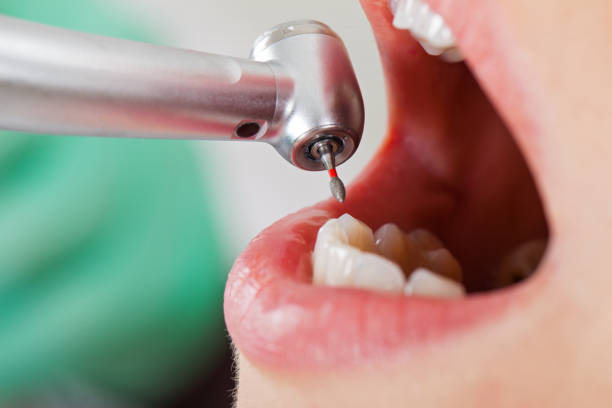 Best Emergency Wisdom Teeth Removal in Allegan, MI
